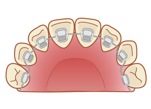 ワイヤー矯正(舌側矯正)